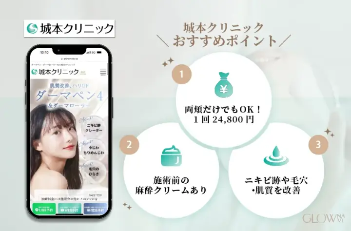 城本クリニックのダーマペンおすすめ広告。両頬だけでも施術可能で1回24,800円、施術前に麻酔クリームがあり、ニキビ跡や毛穴、肌質改善に対応できることを紹介した図