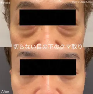 切らない目の下のクマ取り