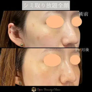 シミ取り全顔