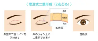 銀座マイアミ美容外科　二重整形埋没法の画像