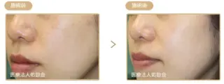 ピコレーザー