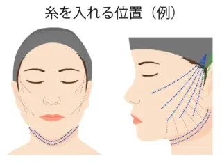 銀座マイアミ美容外科　糸リフトの画像