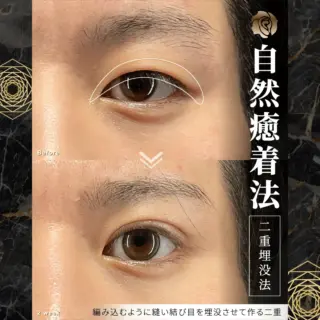 韓国式埋没6点