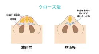 銀座マイアミ美容外科　鼻尖形成の画像