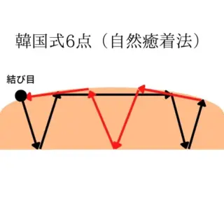 Rosa Beauty Clinc 韓国式6点（自然癒着法）　施術メニュー画像