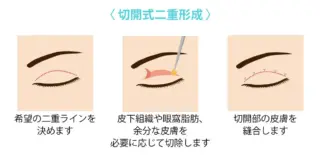 銀座マイアミ美容外科　二重整形切開法の画像
