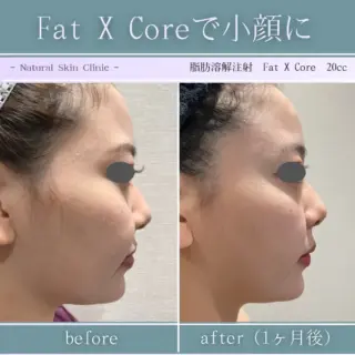 脂肪溶解注射