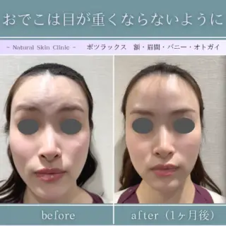 ボツラックス