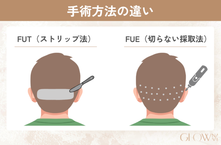 自毛植毛の採取方法の違いを解説。FUT（ストリップ法）は後頭部の毛を帯上に切り取る。FUE（切らない採取法）は毛根を1本ずつくり抜く