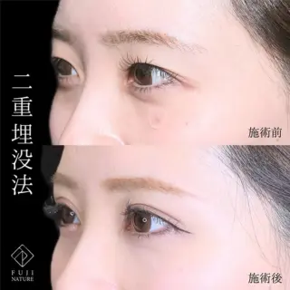 二重埋没