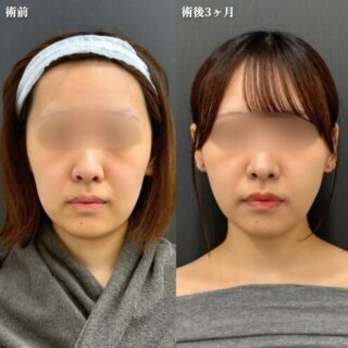 アポロン式小顔脂肪吸引(5エリア)+糸リフト(アルテミスリフトスタンダード4本+アルテミスリフトプレミアム4本）