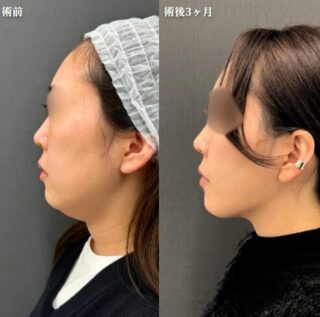 頬・顎脂肪吸引＋糸リフト＋シワ取りボトックス