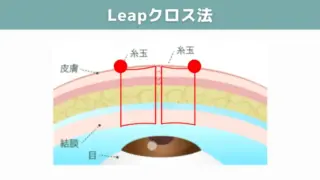 Leap beauty clinic　Leapクロス法　施術メニュー画像