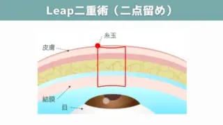 Leap beauty clinic　Leap二点留め　施術メニュー画像
