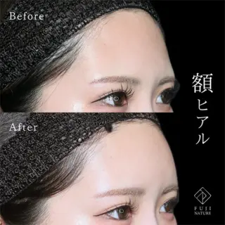 額 ヒアルロン酸注入