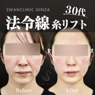 法令線糸リフト