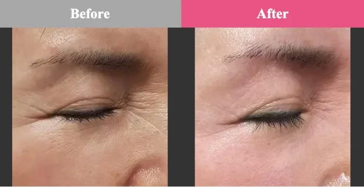 品川美容外科 エリシスセンス 効果 シワ