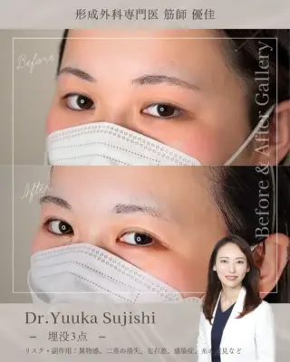 フォーエバー法（3点連結式埋没法）埋没法