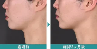 湘南美容クリニックデンシティ症例写真