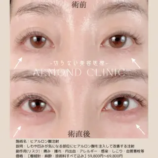 涙袋ヒアルロン酸注射(VOLBELLA®︎ XC)