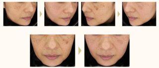 ルメッカ（3回施術）