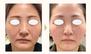 HIFUドット・リニア