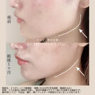 エラボトックス韓国製