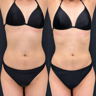 腹部脂肪吸引/エルサ（LSSA）