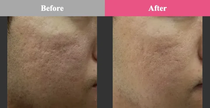 品川美容外科 エリシスセンス 効果 毛穴