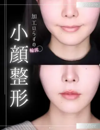 小顔整形