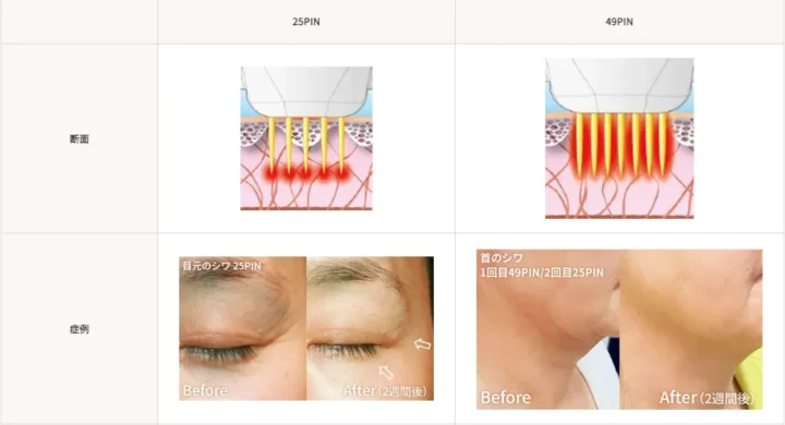 TAクリニック エリシスセンス 断面・症例写真