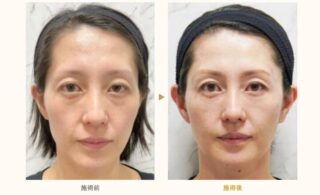 ヒアルロン酸注射