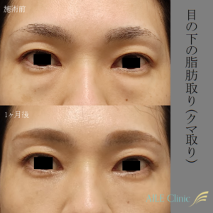 クマ取り（目の下の脂肪取り）