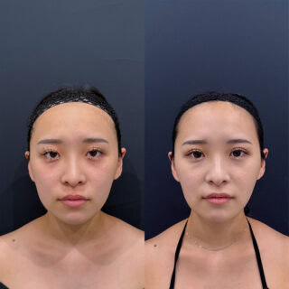 顔の脂肪吸引/エルサ（LSSA）