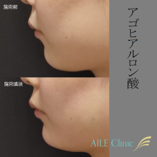 アゴヒアルロン酸