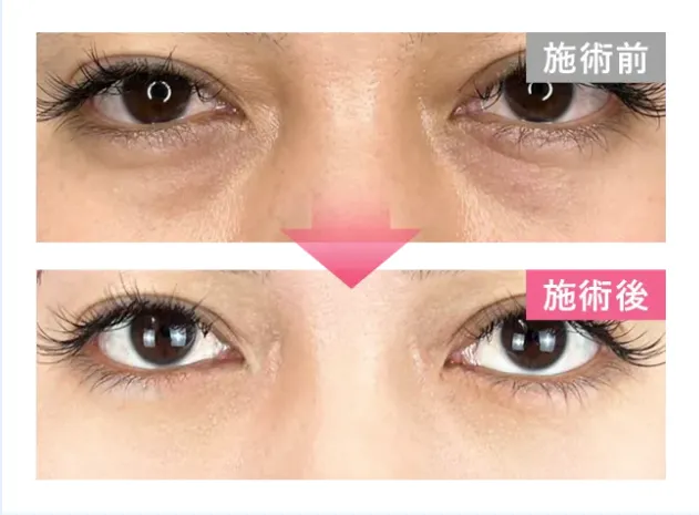 TCB クマ取り　症例写真