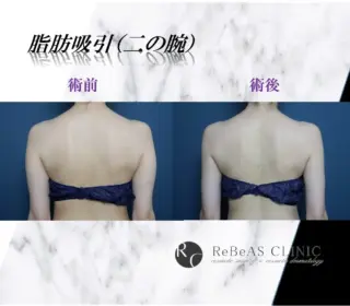 脂肪吸引(二の腕)