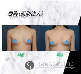 豊胸(脂肪注入)