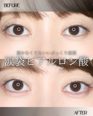 涙袋ヒアルロン酸