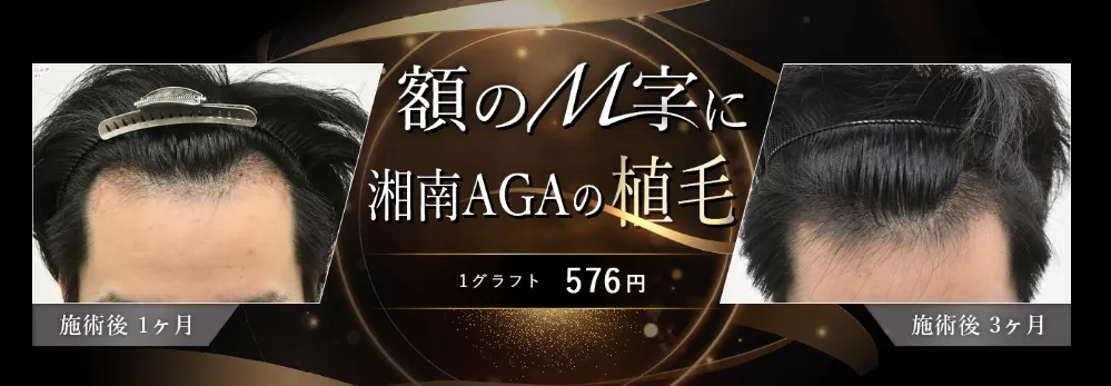 湘南AGAクリニック自毛植毛バナー画像
