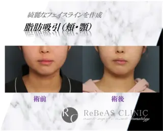 脂肪吸引(頬・顎)