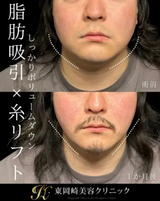 顎下脂肪吸引、頬下脂肪吸引、ジョールファット、糸リフト