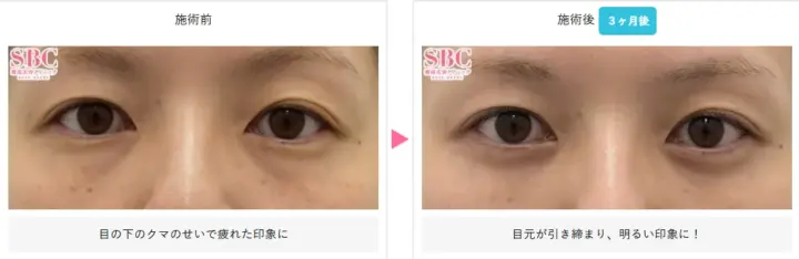 湘南美容クリニック 目の下のクマ取り 症例写真