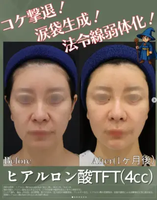 ヒアルロン酸注射