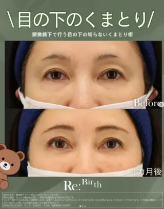 目の下のくまとり