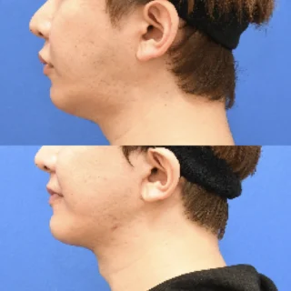 【フェイスリフト/ネックリフト】