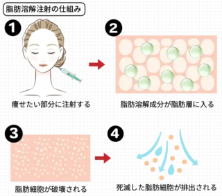 L’amour clinic Tokyo 脂肪溶解注射