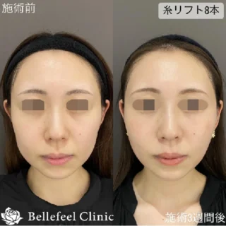 【糸リフト】8本(テスリフト4本＋Nコグ4本)