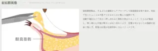 Re:Birth Clinic　施術メニュー画像　経結膜脱脂
