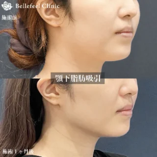 【脂肪吸引】顎下